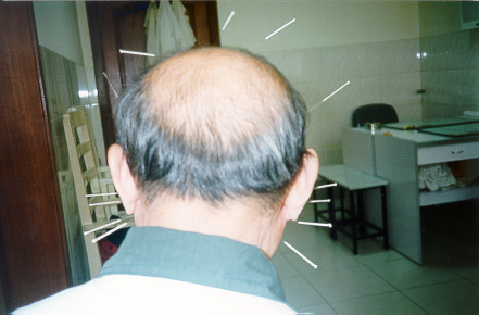 acupuncture-8.jpg